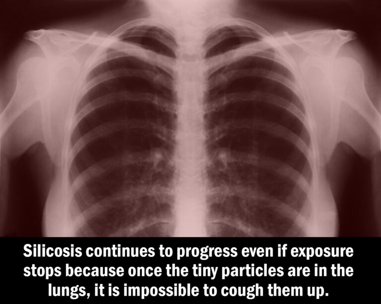 Study shows link between silica exposure and silicosis, lung cancer The Dysart Law Firm, P.C.